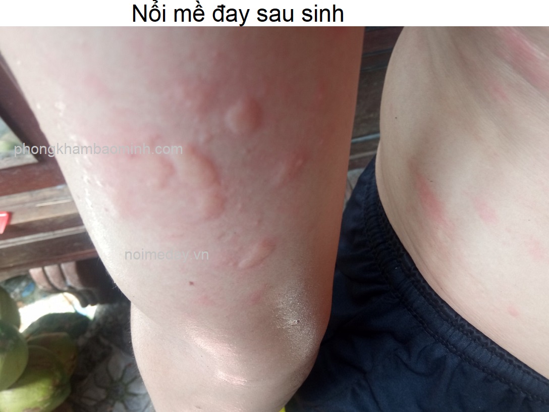 Hình ảnh Nổi mề đay sau sinh